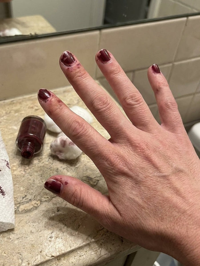Esmalte desconchado y manchas en la piel